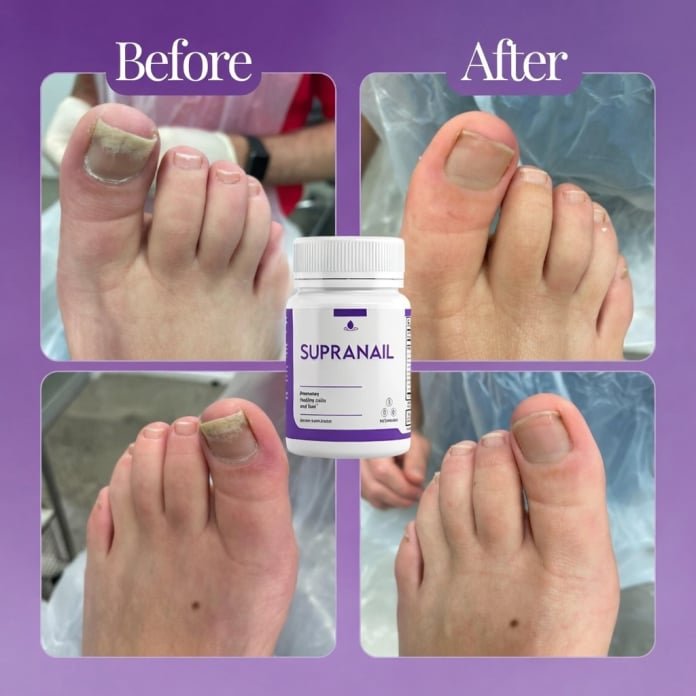 SupraNail SupraNail 30 days results image